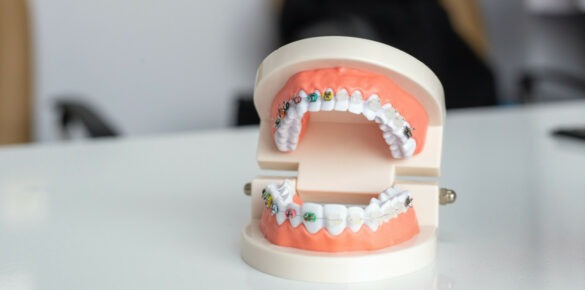 Kiedy warto założyć aparat ortodontyczny?